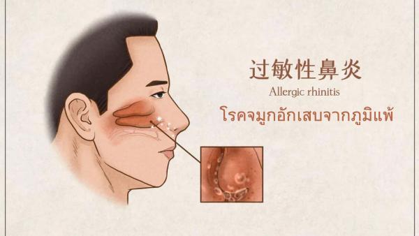 Allergic Rhinitis (โรคจมูกอักเสบจากภูมิแพ้)