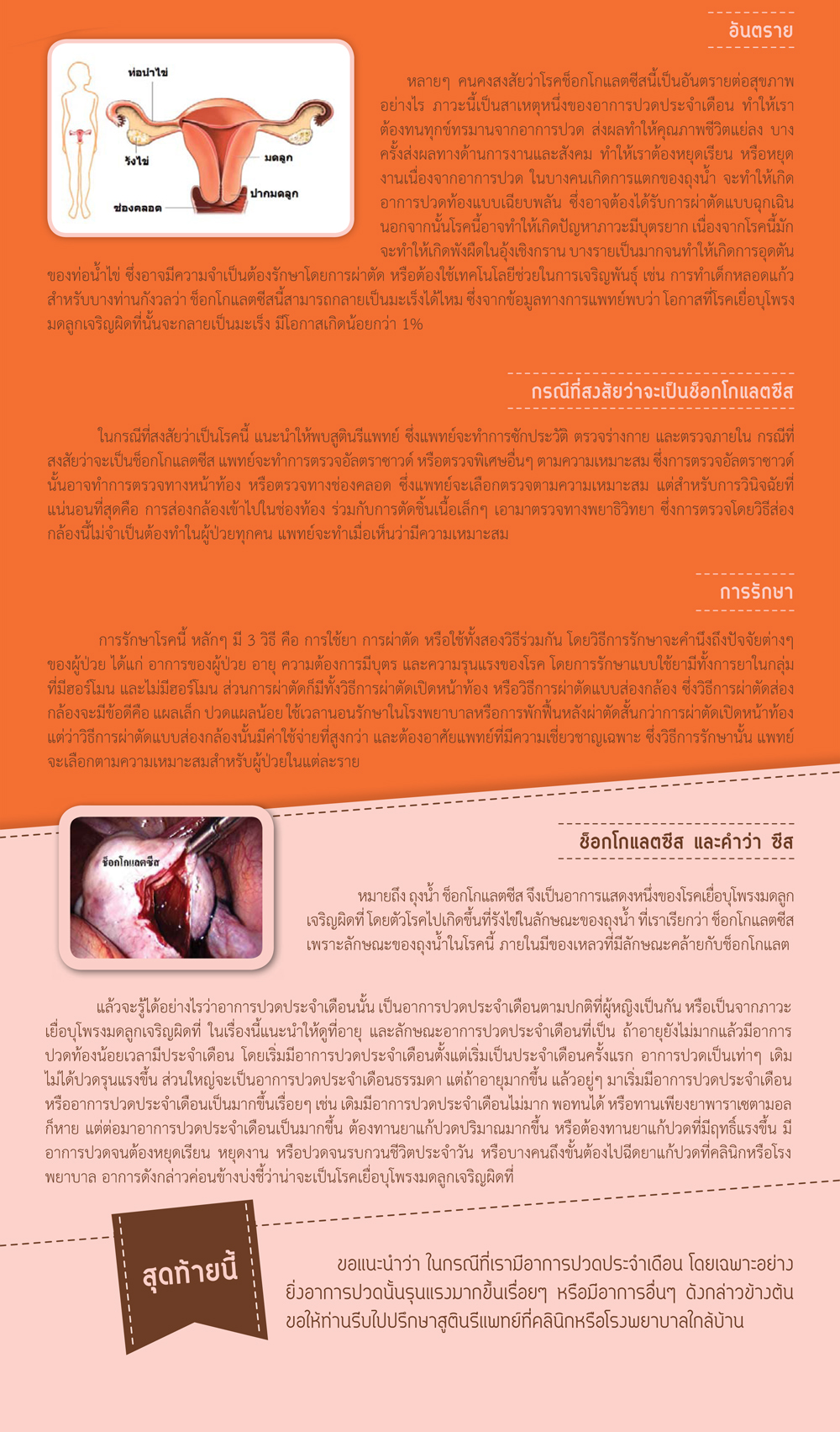 ช็อกโกแลตซีส