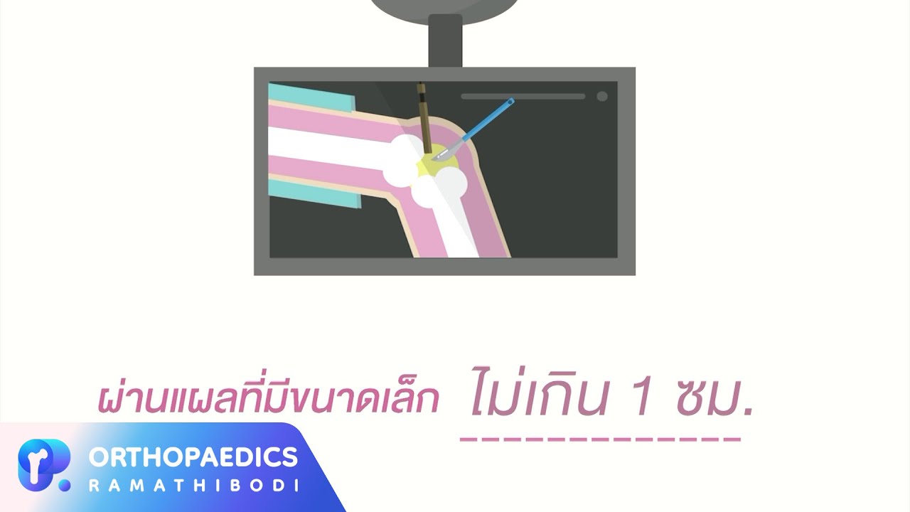 การผ่าตัดส่องกล้องข้อเข่าแบบวันเดียวกลับ (AKAS : Ambulatory Knee Arthroscopic Surgery)