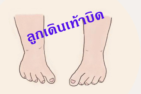 ลูกเดินเท้าบิดเข้าด้านใน