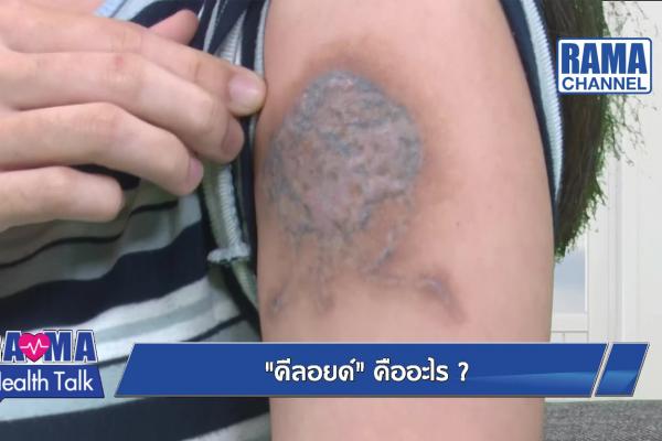 คีลอยด์คืออะไร ?