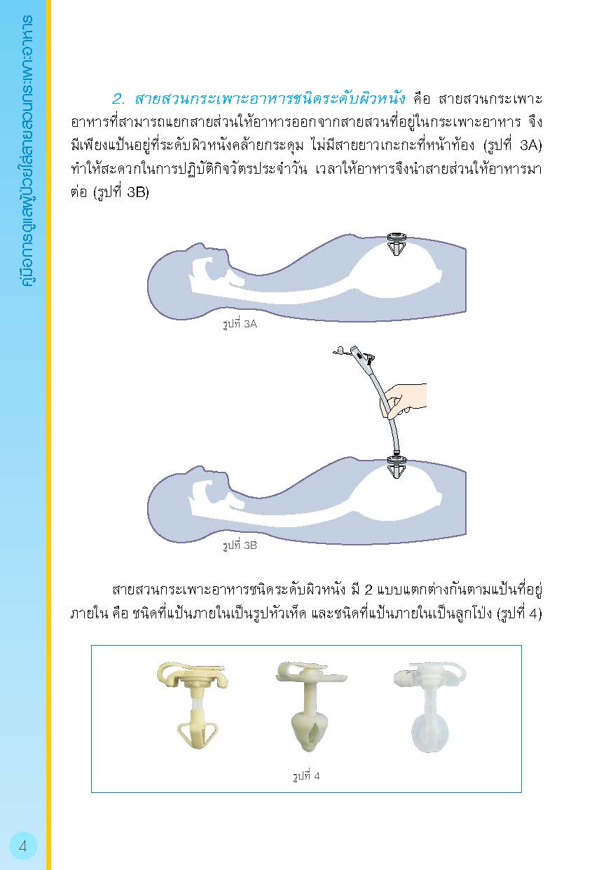 การดูแลผู้ป่วยใส่สายสวนกระเพาะอาหาร