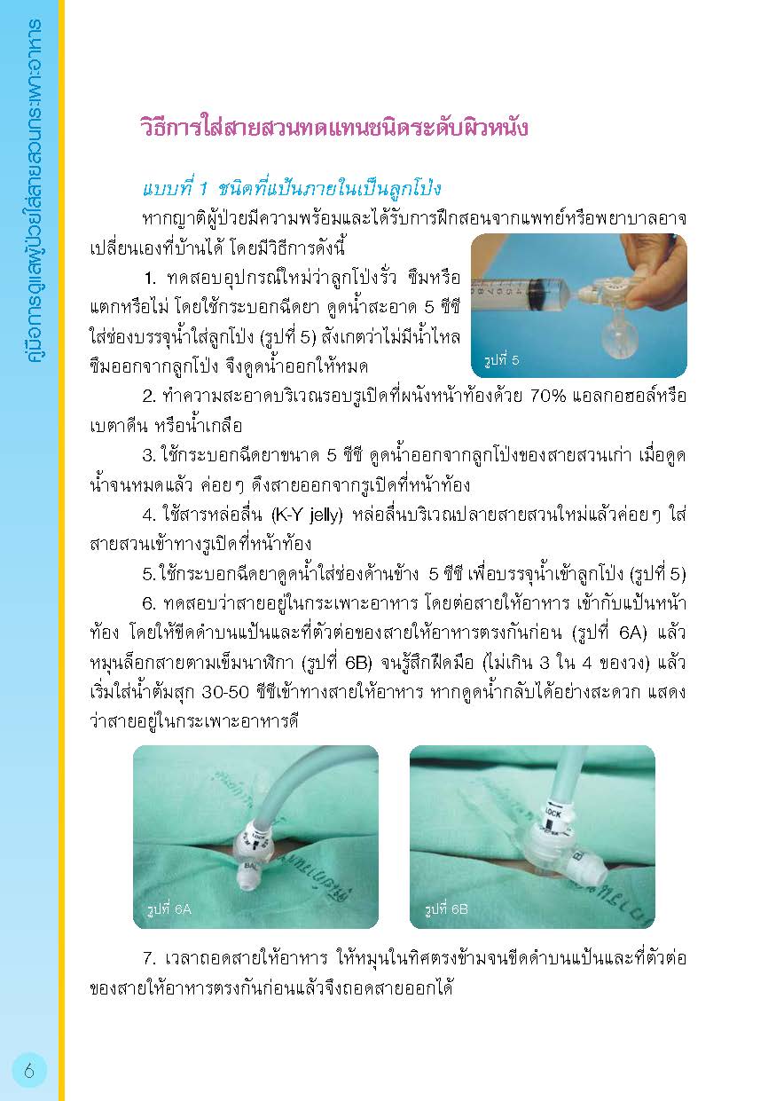 การดูแลผู้ป่วยใส่สายสวนกระเพาะอาหาร