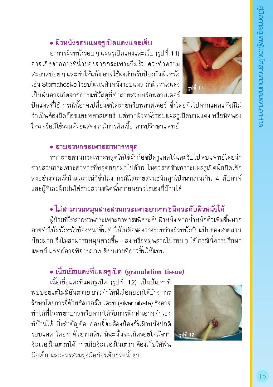 การดูแลผู้ป่วยใส่สายสวนกระเพาะอาหาร