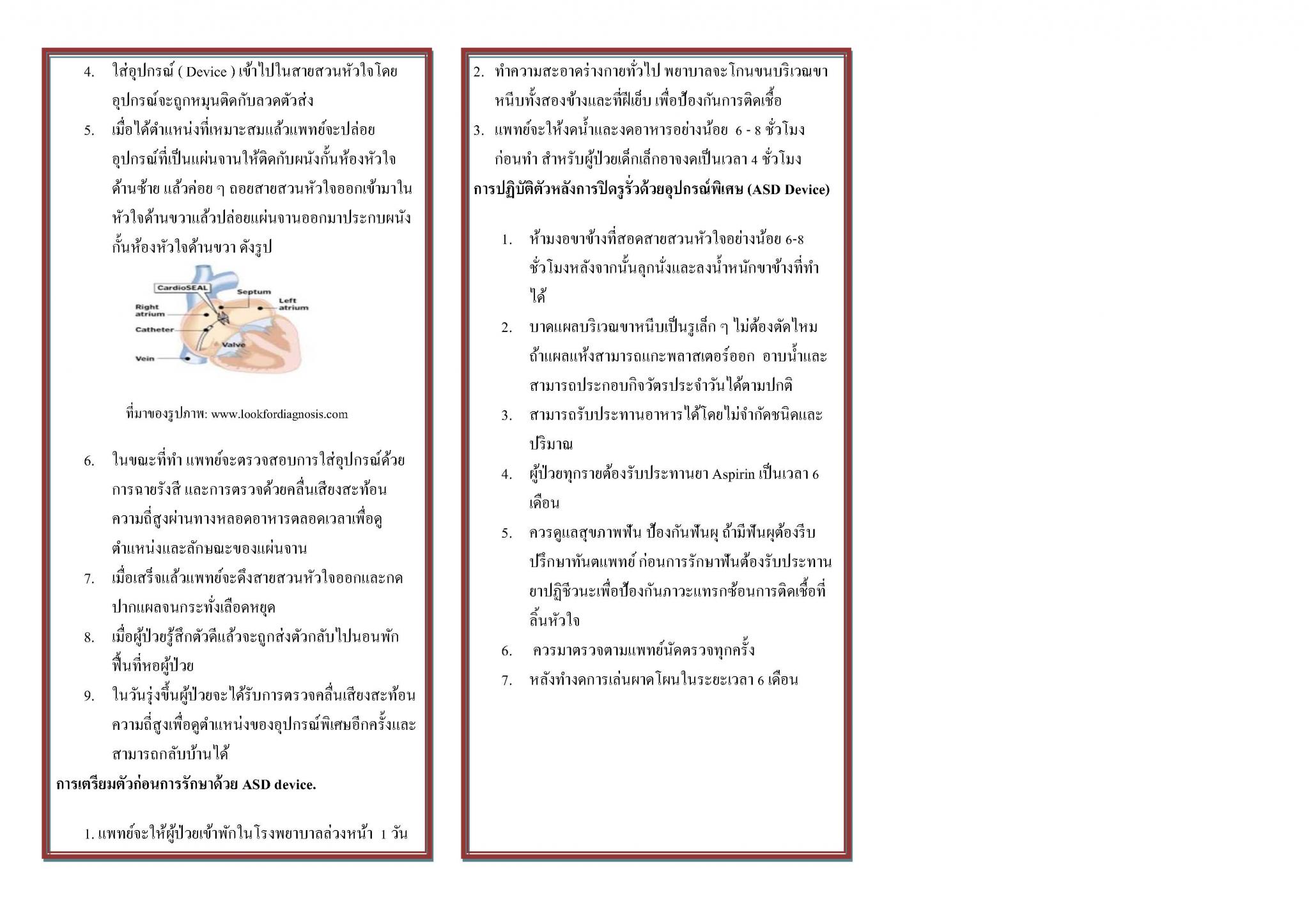 การปิดรูรั่วผนังกั้นหัวใจห้องบนด้วยอุปกรณ์พิเศษ