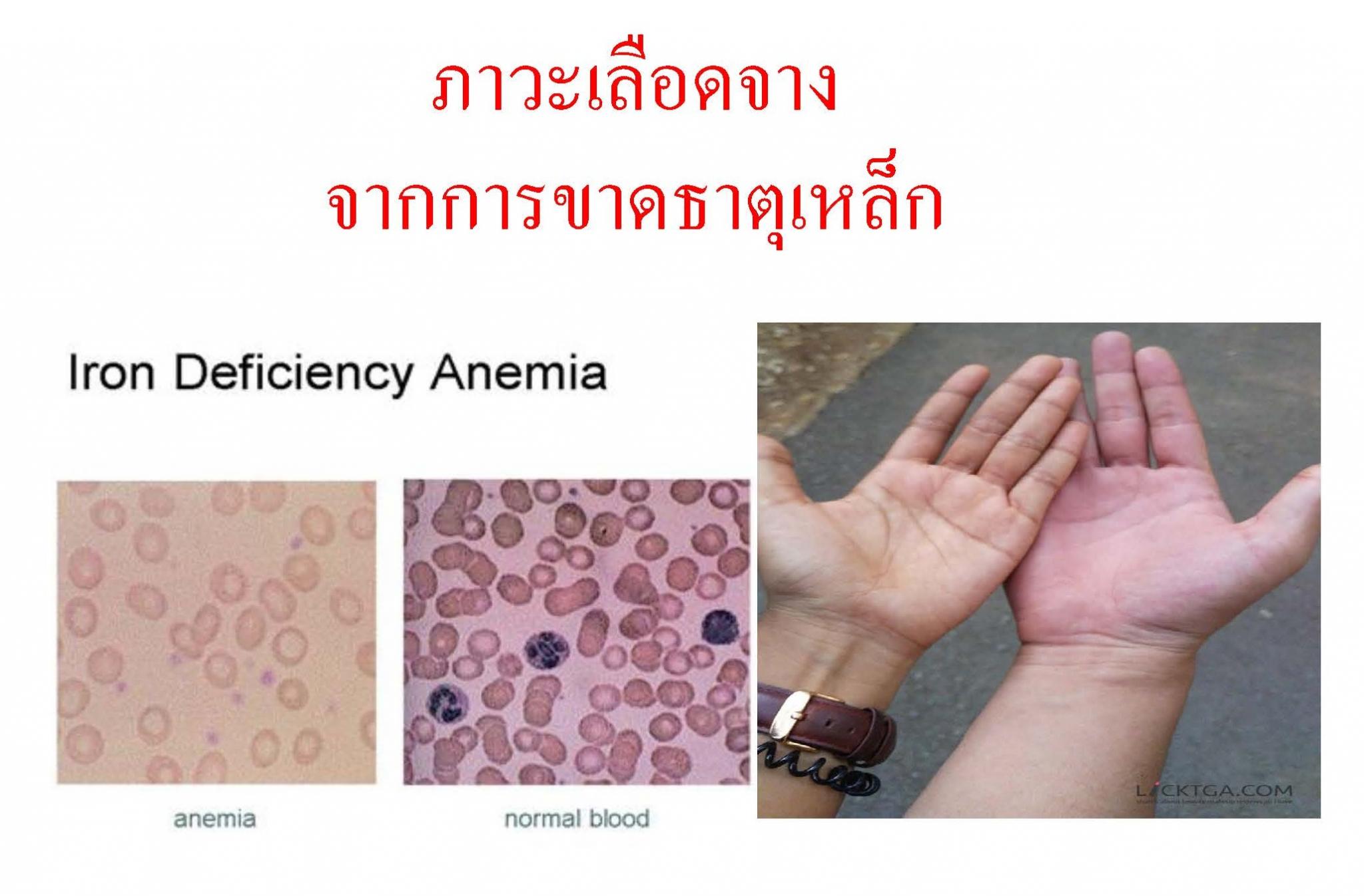 ภาวะเลือดจางจากการขาดธาตุเหล็ก