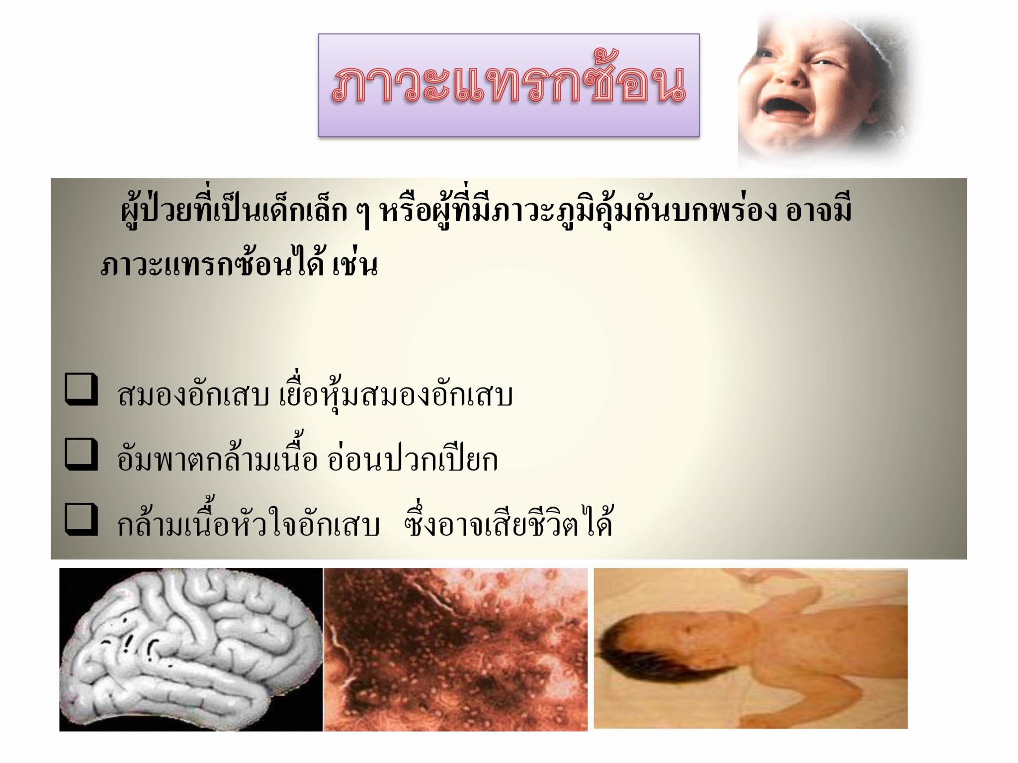 โรคมือ-เท้า-ปาก
