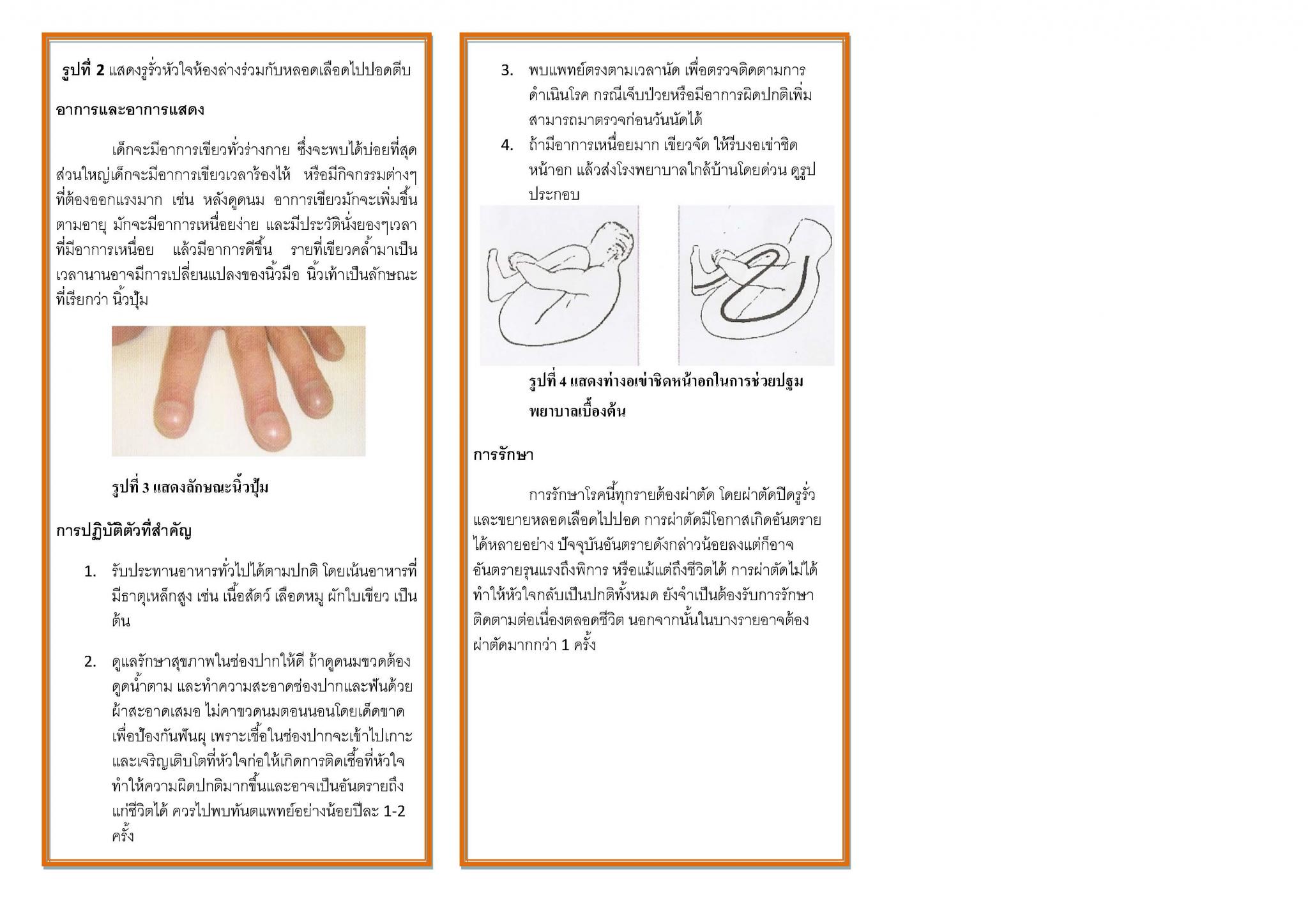 รูรั่วที่หัวใจห้องล่างร่วมกับลิ้นหัวใจไปปอดตีบ