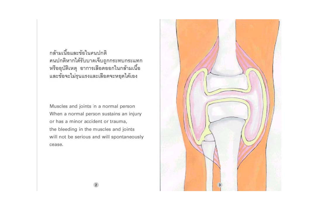 อยู่อย่างมีความสุขกับโรคเลือดออกง่ายฮีโมฟีเลีย