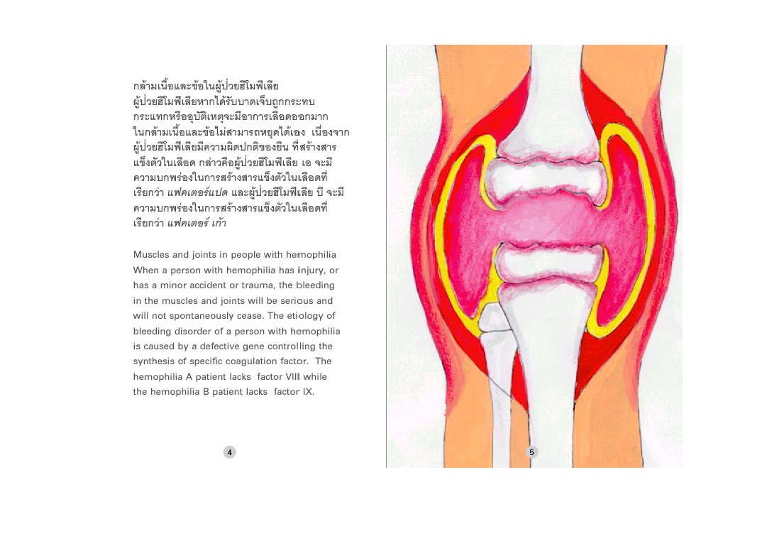 อยู่อย่างมีความสุขกับโรคเลือดออกง่ายฮีโมฟีเลีย