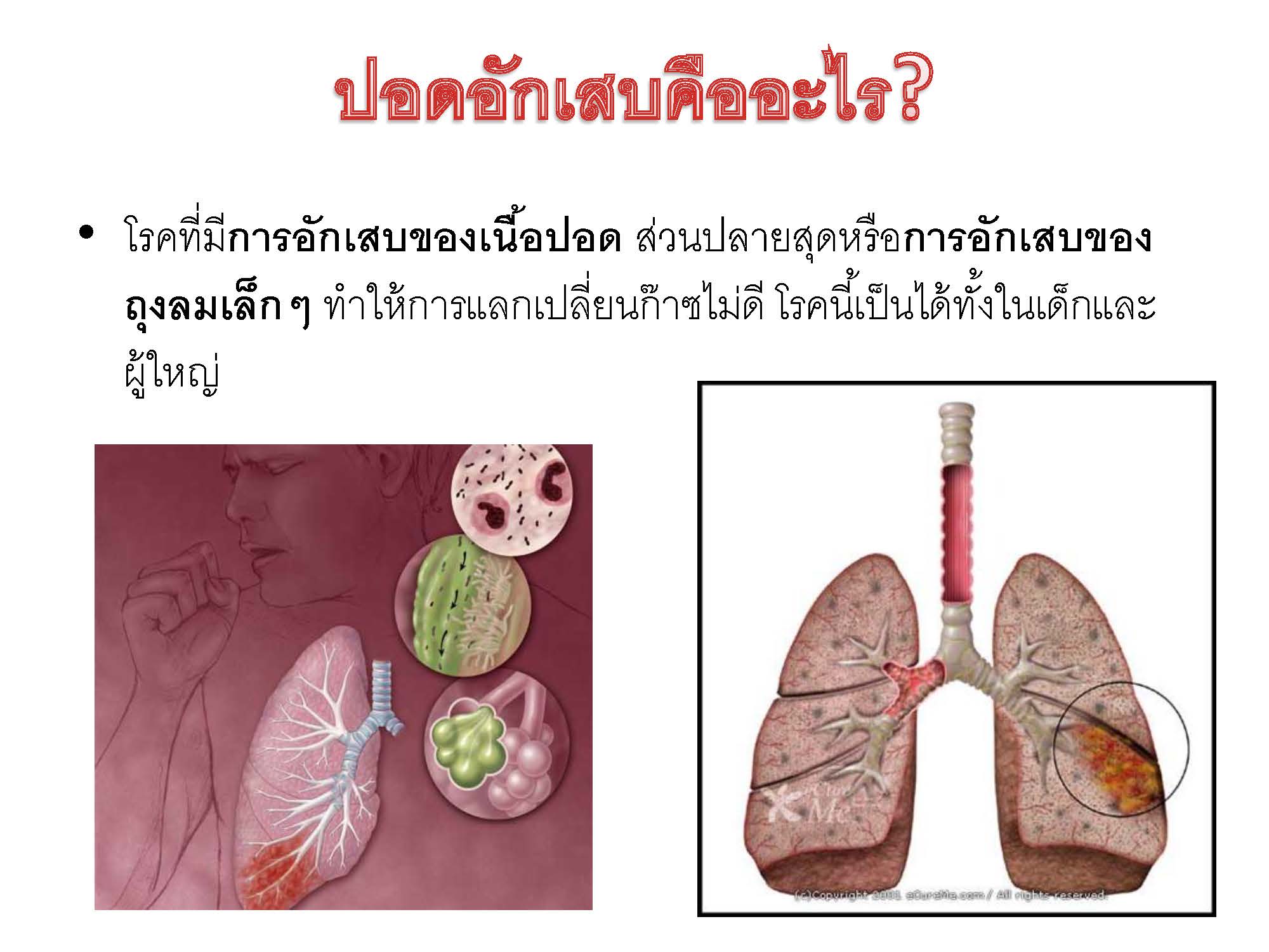 โรคปอดอักเสบ