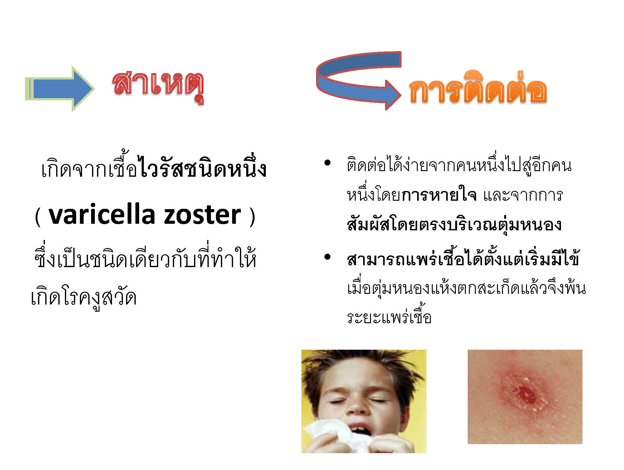 โรคสุกใส