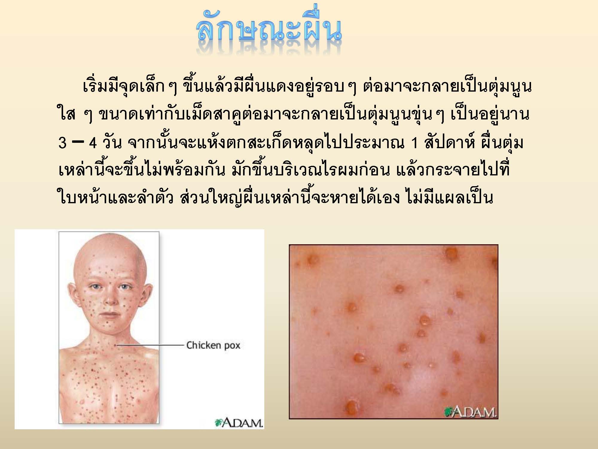 โรคสุกใส