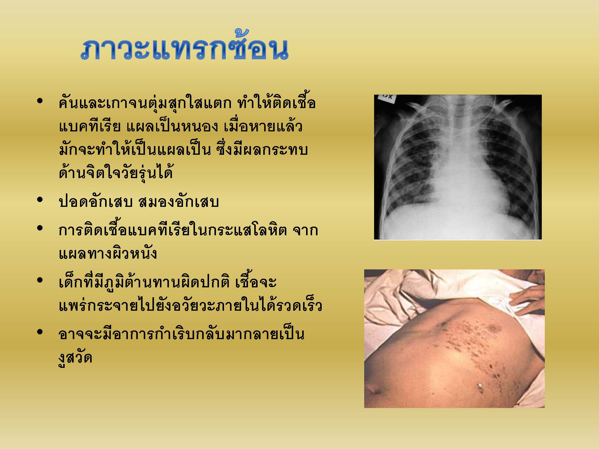 โรคสุกใส