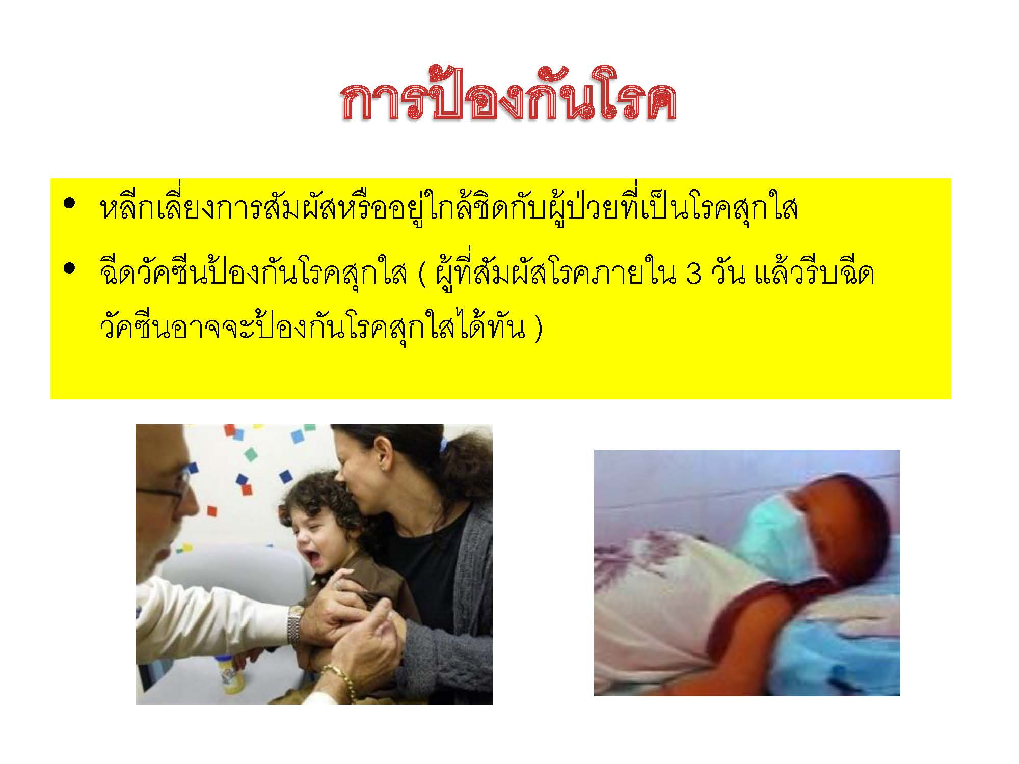โรคสุกใส