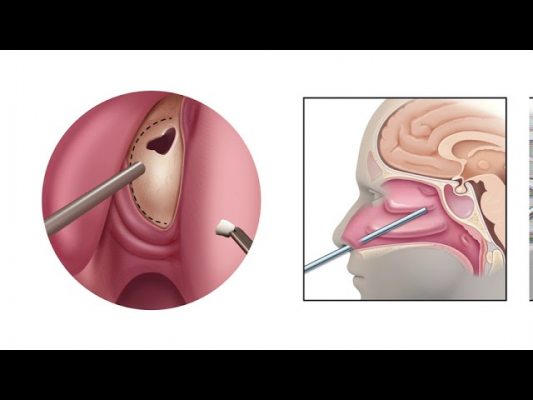 วิดีโออธิบายเทคนิคการผ่าตัดส่องกล้อง (Endoscopic Surgery Animation)
