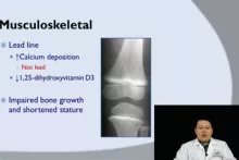 lecture สรุปเรื่อง lead poisoning ไว้สั้นๆใน 25 นาที