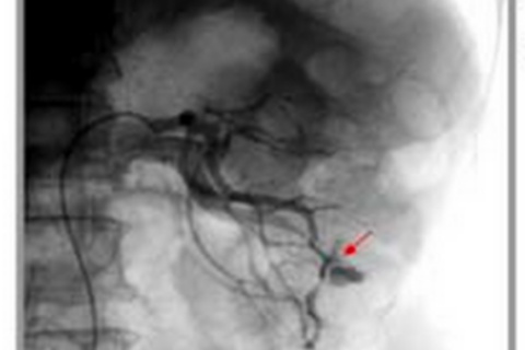 การอุดเส้นเลือด (Embolization)