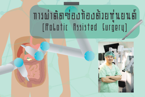 การผ่าตัดช่องท้องด้วยหุ่นยนต์ (Robotic Assisted Surgery)