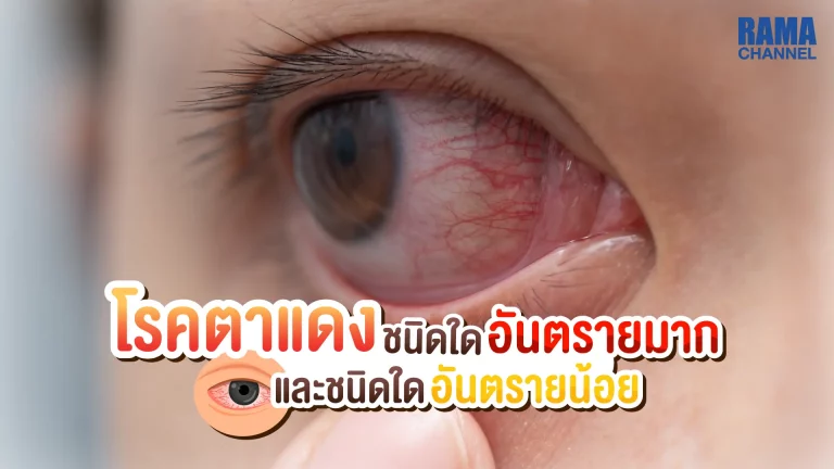 ตาแดง หรือ โรคตาแดง เป็นภาวะความผิดปกติที่เกิดขึ้นที่บริเวณตาขาว เนื่องจากหลอดเลือดที่บริเวณเยื่อบุตาขาวเกิดการขยายตัวโดยจะเห็นเป็นสีแดง