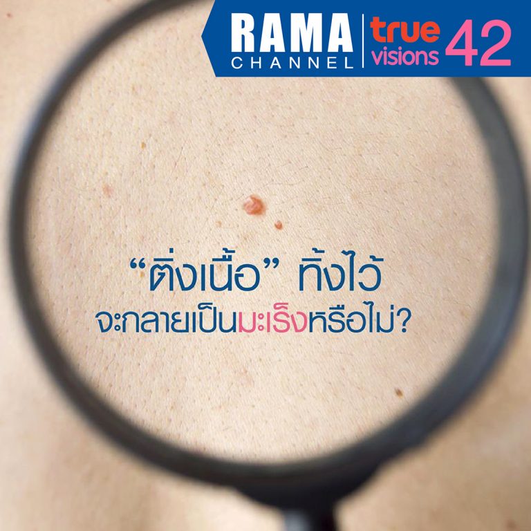 “ติ่งเนื้อ” ทิ้งไว้จะกลายเป็นมะเร็งหรือไม่?