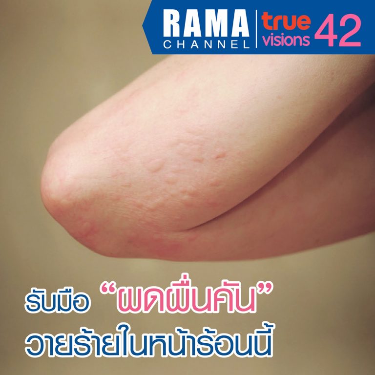 ผดผื่นคัน วายร้ายในหน้าร้อนนี้