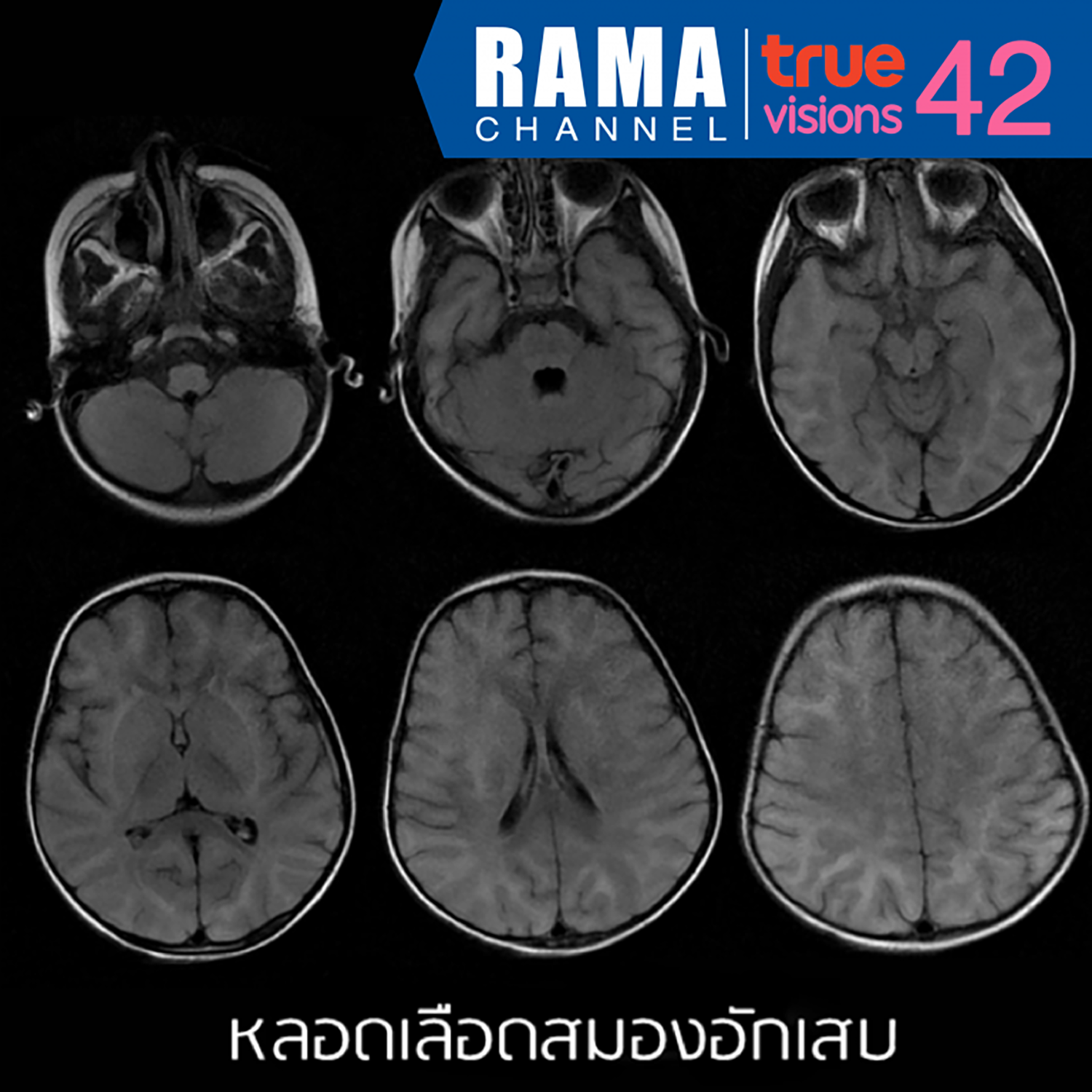 โรคหลอดเลือดสมองอักเสบ