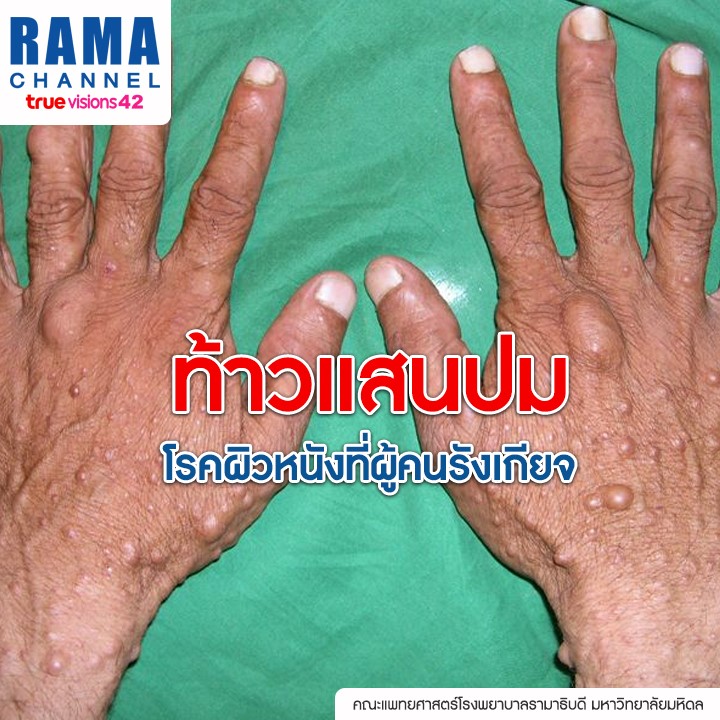 ท้าวแสนปม โรคผิวหนังที่ผู้คนรังเกียจ