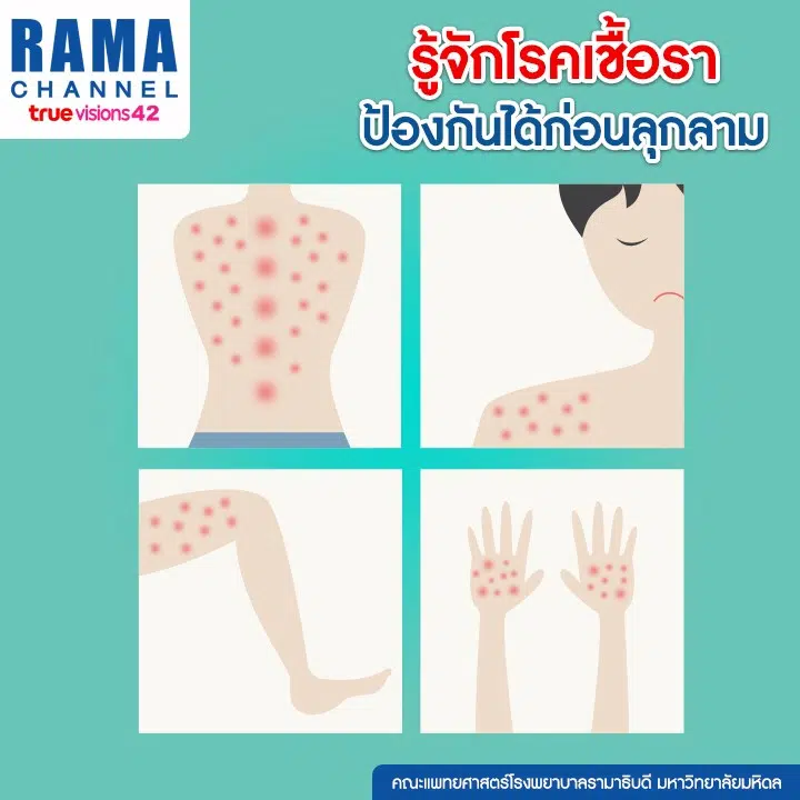 เชื้อราผิวหนัง โรคเชื้อรา อาการ และวิธีป้องกันที่ควร