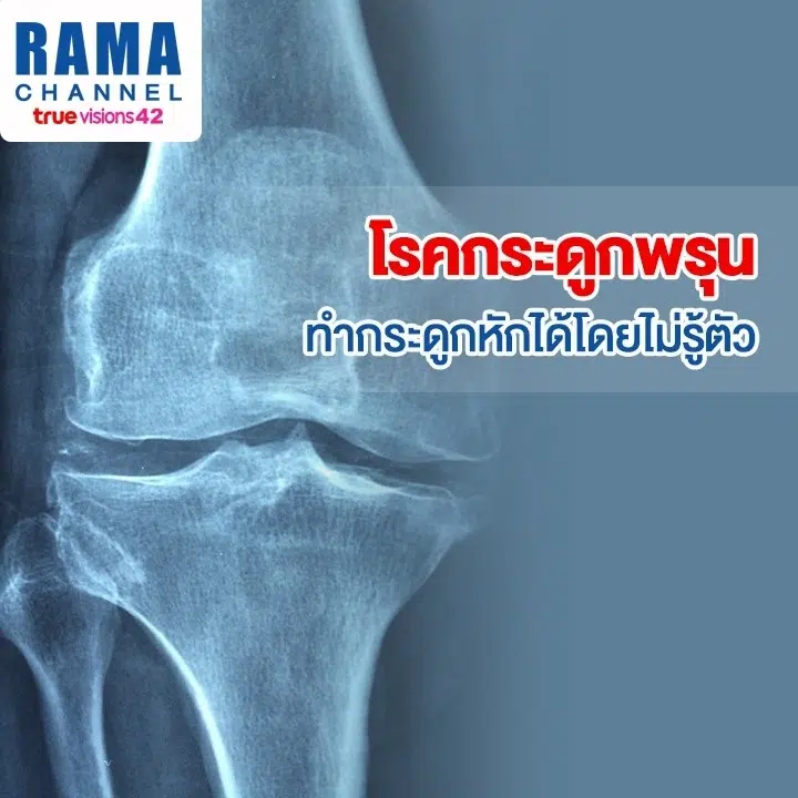 โรคกระดูกพรุน ทำกระดูกหักได้โดยไม่รู้ตัว
