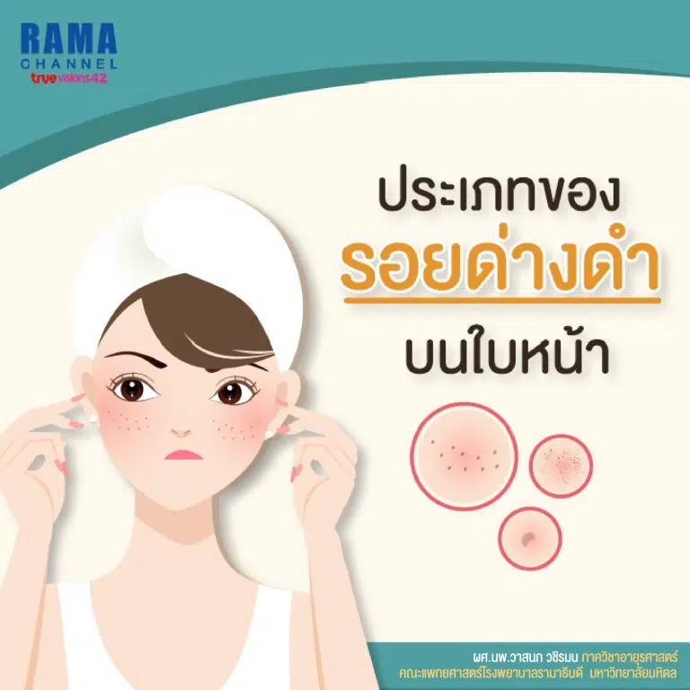 ประเภทรอยดำบนใบหน้า1