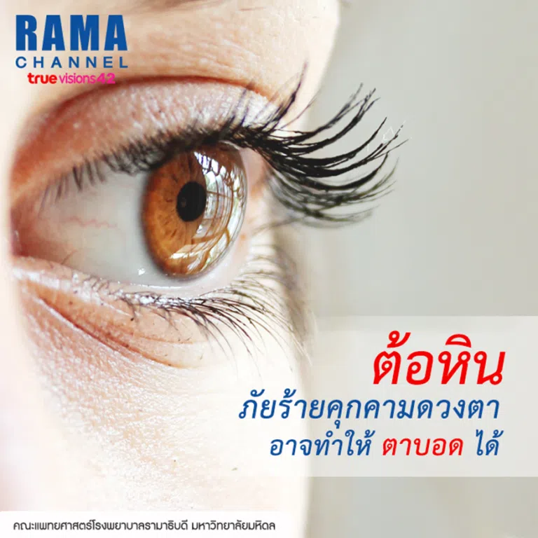 ต้อหิน