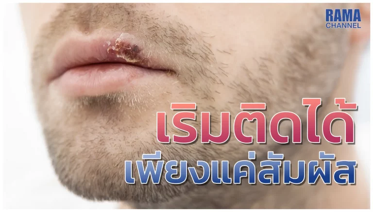 เริม ติดได้ เพียงแค่สัมผัส !