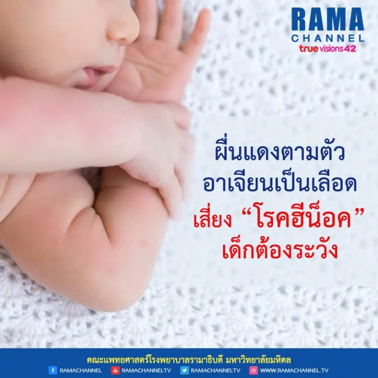 ผื่นแดงตามตัว อาเจียนเป็นเลือด เสี่ยง “โรคฮีน็อค” เด็กต้องระวัง