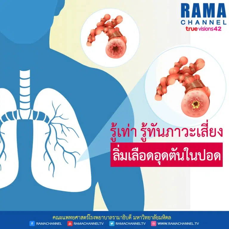 รู้เท่ารู้ทันภาวะเสี่ยง “ลิ่มเลือดอุดตันในปอด”