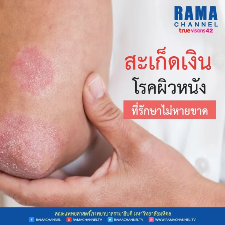โรคผิวหนัง โรคสะเก็ดเงิน