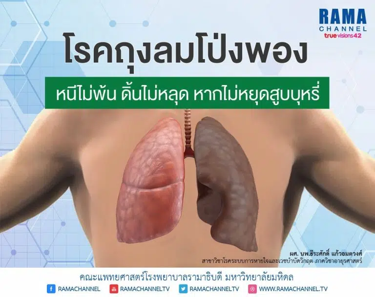โรคถุงลมโป่งพอง1