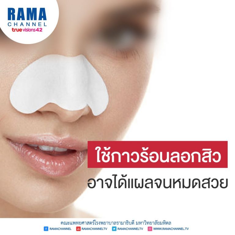 ใช้กาวร้อน ลอกสิว อาจได้แผลจนหมดสวย