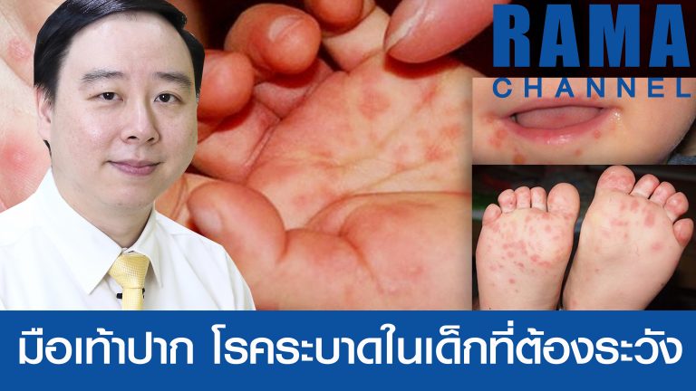 โรคมือเท้าปาก