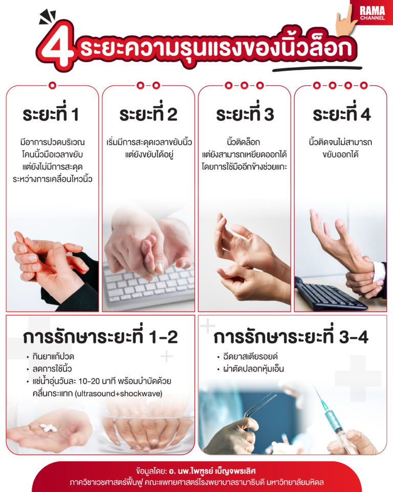 4 ระยะความรุนแรงของ นิ้วล็อก