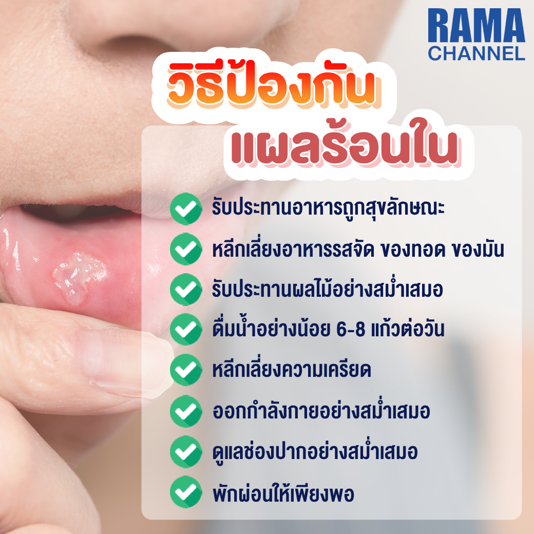 ร้อนใน แผลในช่องปากที่ควรระวัง