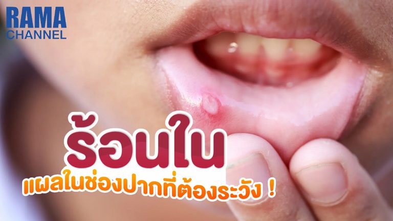 ร้อนใน แผลในช่องปากที่ควรระวัง