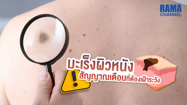 บทความ เรื่อง ตากแดดบ่อย ๆ มีไฝขึ้นและแตกเป็นแผล หรือมีแผลที่ ผิวหนัง เรื้อรังเป็นระยะเวลานาน อาจเป็นสัญญาณเตือน โรค มะเร็งผิวหนัง