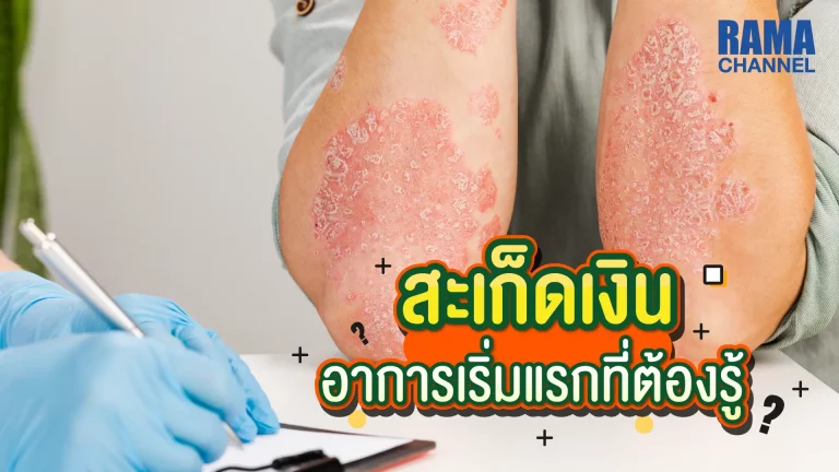 โรคสะเก็ดเงิน อาการเริ่มแรกที่ต้องรู้ !