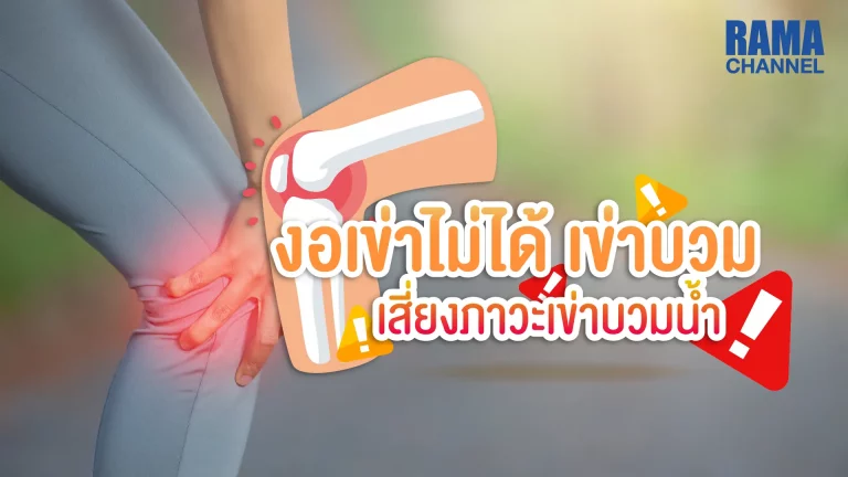 บทความ เรื่อง ปวดเข่า งอเข่าไม่ได้ เข่าบวม อาการนี้เกิดจากความผิดปกติของน้ำในข้อเข่าจนทำให้อวัยวะภายในของข้อเข่าเกิดการอักเสบจนทำให้เกิด ภาวะเข่าบวมน้ำ ได้
