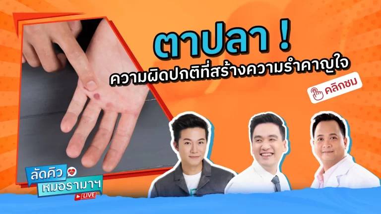 ตาปลา คือ ผิวหนังซึ่งหนาตัวขึ้นมาเนื่องจากการกดทับหรือการลงน้ำหนักของเท้า บริเวณนั้น ซ้ำ ๆ เป็นเวลานาน เป็นโรคที่สร้างความรำคาญใจอย่างมาก