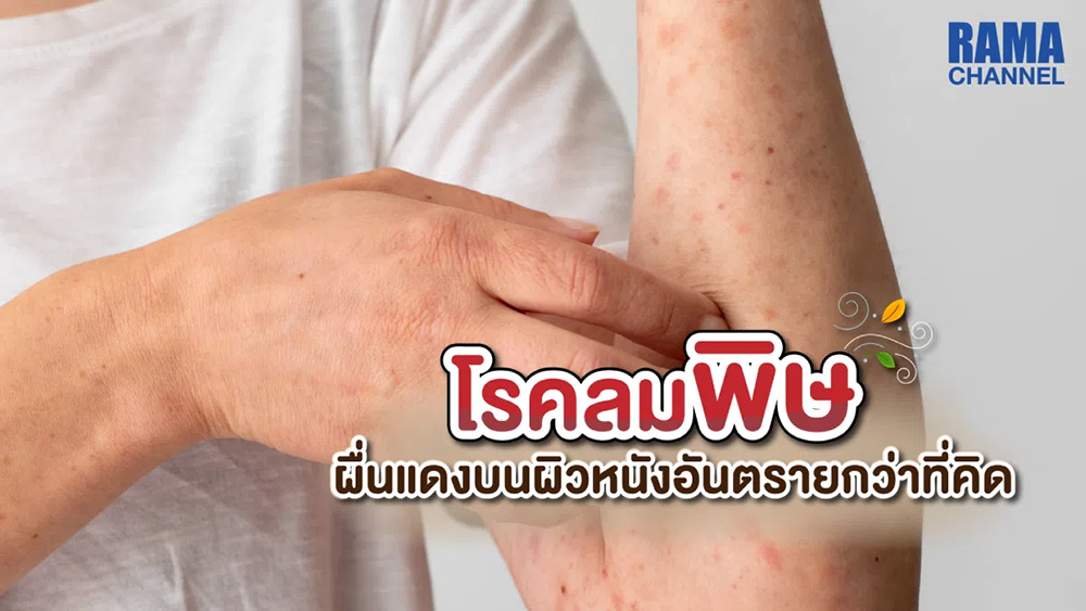 โรคลมพิษ โรคที่ผิวหนังมีอาการเป็นผื่นหรือนูนแดง ไม่มีขุย ทำให้มีอาการคัน ผื่น จะเกิดขึ้นเร็วและกระจายตามลำตัวแขน ขา จะอยู่ไม่นานไม่เกิน 1 วัน