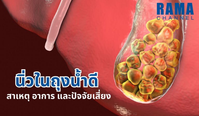 นิ่วในถุงน้ำดี ดีเกิดจากการสะสมของสารในน้ำดี ส่งผลให้ปวดท้องจุกเสียด ควรทราบสาเหตุ อาการ และปัจจัยเสี่ยงเพื่อรับมือและป้องกันอย่างถูกวิธี