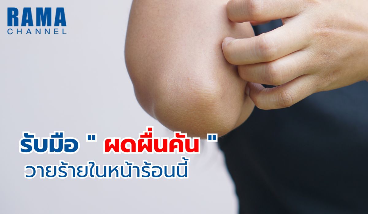ผดผื่นคัน หน้าร้อน ทำให้ระคายเคืองผิว ควรดูแลผิวให้สะอาด เลือกใส่เสื้อผ้าระบายอากาศได้ดี และหลีกเลี่ยงการสัมผัสแสงแดดโดยตรง