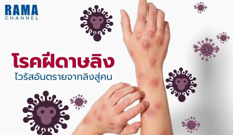 โรคฝีดาษลิง ไวรัสอันตรายจากลิงสู่คน